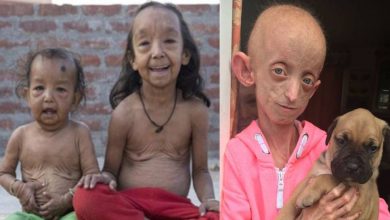 Photo of หายากโรคปุ่มเบนจามิน progeria ทำให้เกิดริ้วรอยอย่างรวดเร็วในเด็ก janiye ปุ่มเบนจามิน bimari ke lakshan samp |  โรคหายาก : โรคหายากเช่นนี้ที่เด็กอายุ 10 ขวบเริ่มปรากฏเมื่ออายุ 100 รู้อาการ