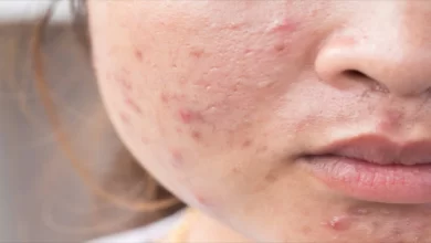 Photo of การเยียวยาที่บ้านเพื่อขจัดสิวและสิวที่ดีกว่าครีมกำจัดสิวเสี้ยน |  Acne & Pimples ถูสิ่งนี้บนใบหน้า สิวจะหายไป มีประโยชน์มากกว่าครีม