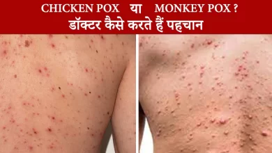 Photo of 6 ความแตกต่างระหว่างไวรัส Monkeypox และไวรัสอีสุกอีใสที่แพทย์แยกความแตกต่างของการติดเชื้อ |  Monkeypox หรืออีสุกอีใส: Monkeypox เกิดขึ้นหรืออีสุกอีใสแพทย์ระบุได้อย่างไร?  รู้ข้อมูลครบ 6 เรื่อง