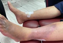 Photo of อาการคอเลสเตอรอลสูง ขาเป็นสัญญาณ ระดับคอเลสเตอรอลสูง อย่ามองข้ามสัญญาณนี้ |  อาการคอเลสเตอรอลสูง: สีของเท้าเปลี่ยนไปหลังจากเพิ่มคอเลสเตอรอล  ตื่นตัวทันที