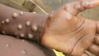 Photo of Monkeypox กำลังกลายเป็นอันตรายมากกว่า 41,000 รายใน 96 ประเทศ|