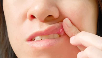 Photo of รักษาแผลในปากด้วยการเยียวยาที่บ้านและบรรเทาอาการปวดทันที nsmp |  แผลในปาก: รักษาด้วยการเยียวยาที่บ้าน คุณจะหายจากแผลในปาก ปวด แสบร้อนได้ทันที