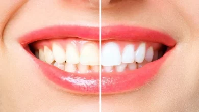 Photo of การฟอกสีฟัน: นำอาหาร 4 ชนิดนี้ออกจากแผนอาหารของคุณเพื่อกำจัดฟันเหลือง sscmp |  การฟอกสีฟัน: ต้องการกำจัดฟันเหลืองหรือไม่?  ดังนั้นให้นำอาหาร 4 ชนิดนี้ออกจากอาหารของคุณทันที